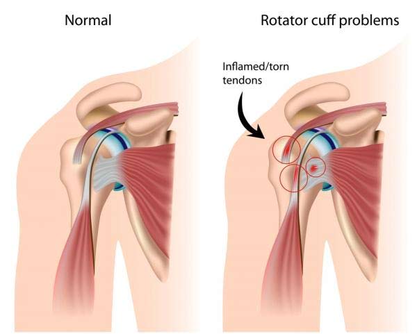 shoulder injury anatomy