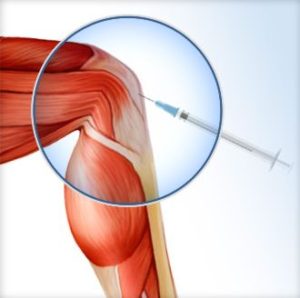 knee pain treatment with platelet rich plasma